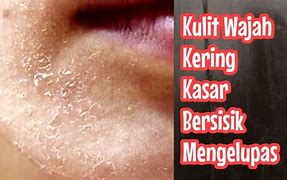 Cara Mengatasi Kulit Kering Gatal Dan Mengelupas